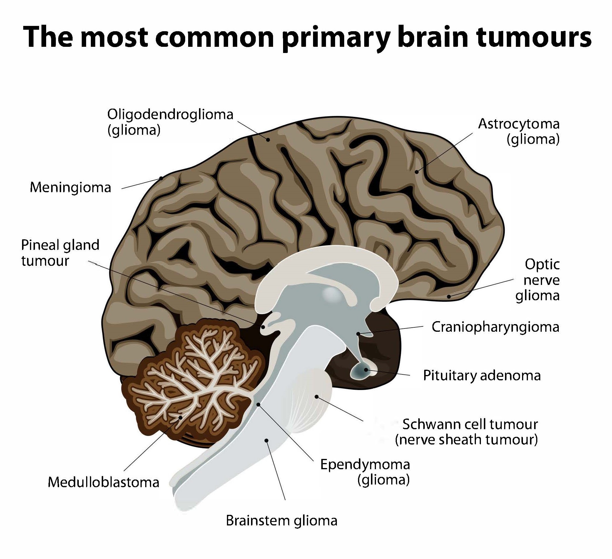 How to Detect Brain Tumours Earlier to Improve Survival